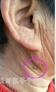 右耳耳垂下有一颗肉痣1.png